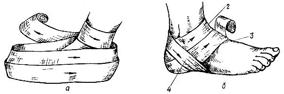эластичное бинтование голеностопного сустава при растяжении. повязки на ногу хирургия. виды бинтовых повязок на нижнюю конечность. повязка на нижние конечности. бинтование культи эластичным бинтом.