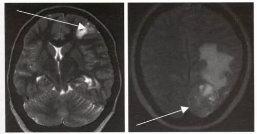 Меланома метастазы в мозг. Метастазы меланомы в головной мозг кт. Меланома головного мозга мрт.