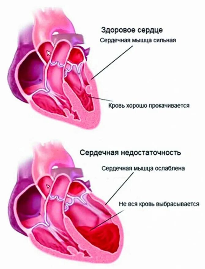 Сильное сердце что делать. Недостаточность сердечно сосудистая 151.6. Острая и хроническая сердечная недостаточность. Острая и хроническая сердечная недостаточность симптомы. ОЦК сердечная недостаточность.