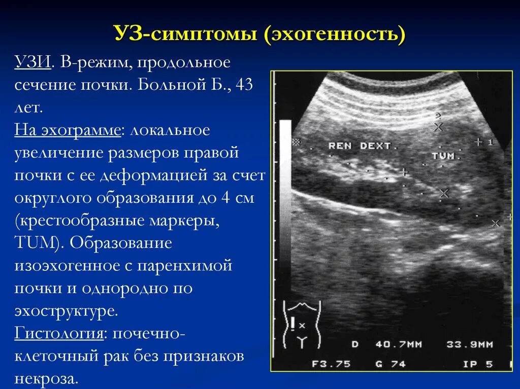 Изоэхогенное образование в почке на УЗИ что это такое. Гипоэхогенное неоднородное образование в почке. Изоэхогенное образование в печени на УЗИ. Образование почки на УЗИ В паренхиме. Что означает эхогенность печени