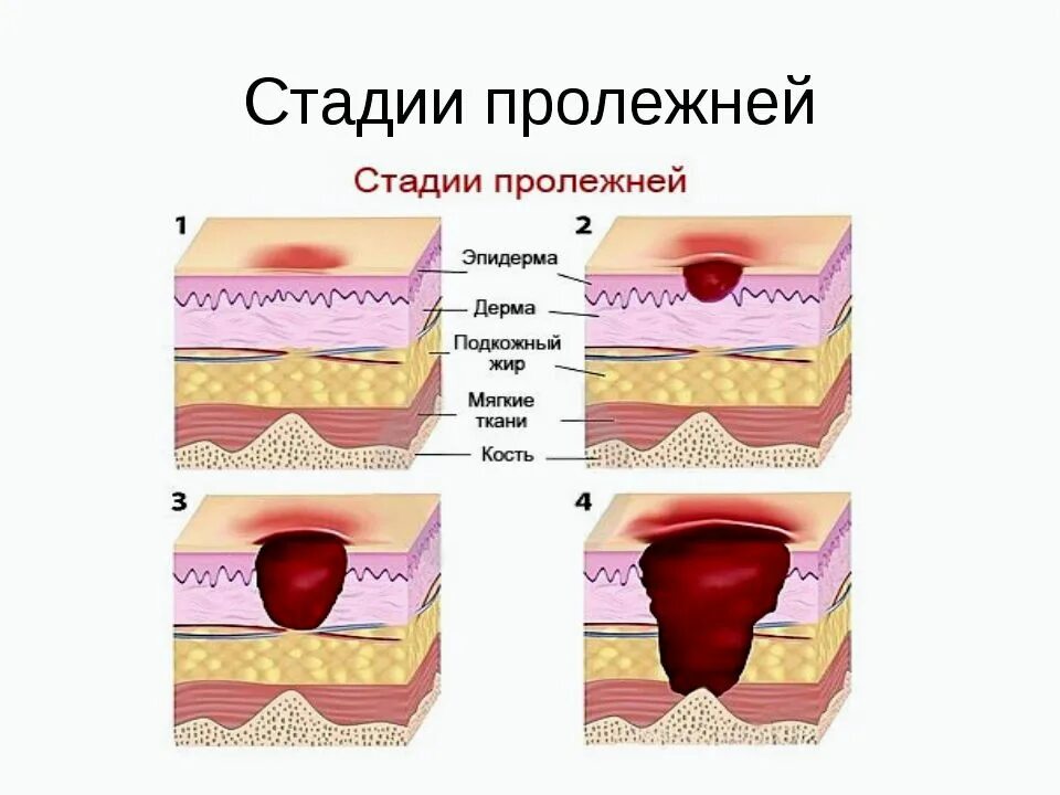 3-4 Степень пролежней у лежачих больных. Симптомы стадий пролежней. 3 Стадия развития пролежней. В классификации пролежней степеней тяжести:. Этапы на 4 стадии