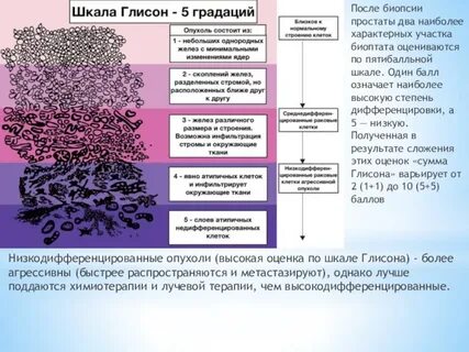 Шкала глиссона предстательной