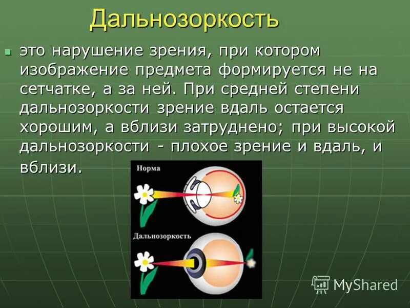 Гиперметропия средней степени глаза. Дальнозоркость. Зрение дальнозоркость. Нарушение зрения дальнозоркость. Дальнозоркость развивается при.