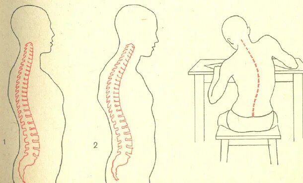 Осанка и искривление позвоночника. Сколиоз позвоночника у школьников. Неправильная осанка искривление позвоночника.