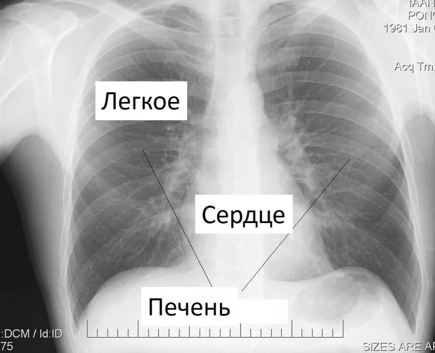 Какие легкие в норме. Рентген грудной клетки норма. Рентген легких норма. Рентгеновские снимки легких норма. Легкие в норме.