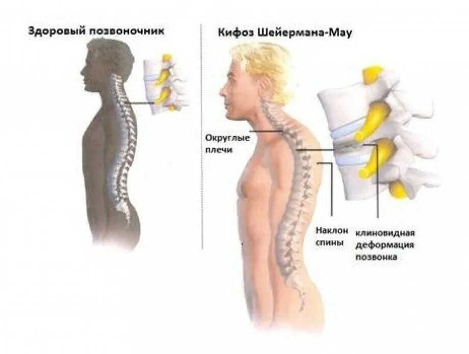 Юношеский кифоз болезнь Шейермана-МАУ. Искривление позвоночника синдром Шейермана МАУ. Кифоз грудного отдела болезнь Шейермана МАУ. Болезнь Шерман МАУ позвоночника.