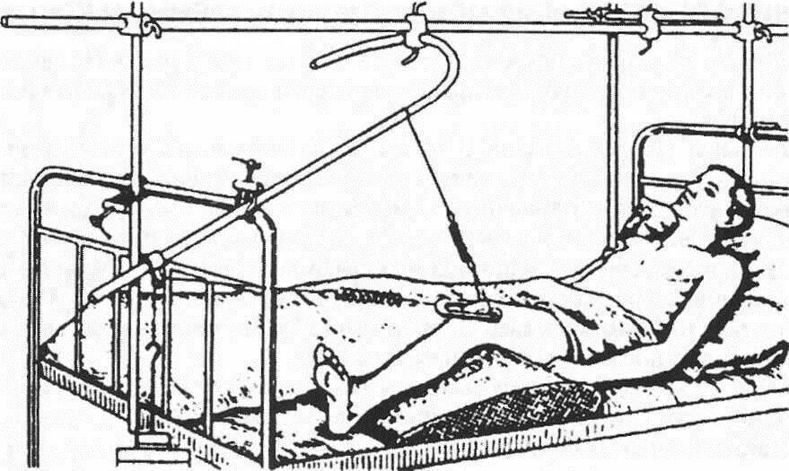 Температура после перелома. Скелетное вытяжение большеберцовой кости. Скелетное вытяжение при чрезвертельном переломе. Скелетное вытяжение при переломе шейки бедра у пожилых. Перелом голени вытяжение.