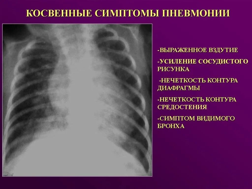 Воспаление легких без температуры признаки у взрослого. Легочные проявления пневмонии. Пневмония симптомы у взрослых.