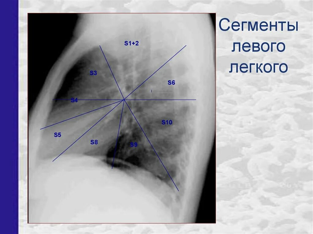 S 1 легкого. Сегмент s1-2 легкого. Сегменты s2-s4 легкого. Сегменты s1 s2 s3 легкого. S10 сегмент легкого.