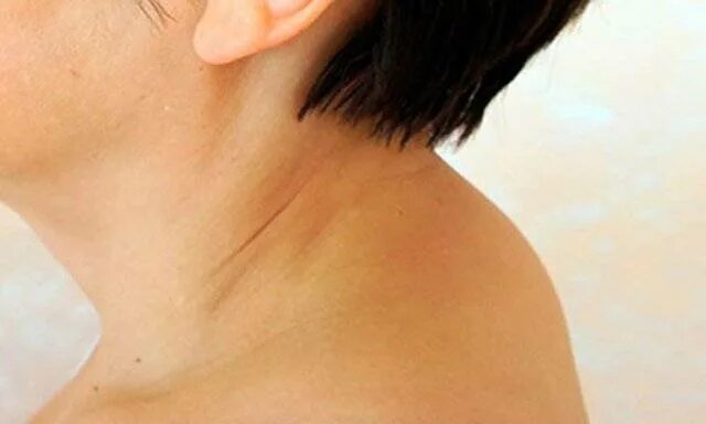 Как убрать шишку на шее. Вдовий горбик аппликатор кузнецова. Как убрать шишку на шее. Климактерический горбик. Климактерический горбик.