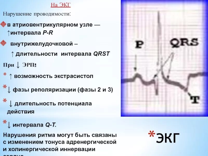 Нарушение внутрижелудочковой проводимости что это у ребенка. Нарушение внутрижелудочкового проведения на экг. нарушение внутрижелудочковой проводимости. проводимость экг. нарушение внутрижелудочковой проводимости на экг.