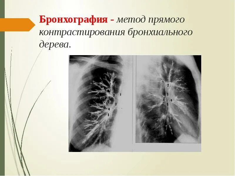 Бронхоэктатическая болезнь бронхография. Бронхоэктатическая болезнь рентген. Бронхоэктатическая болезнь бронхография. Симптом воздушной бронхографии. Бронхография пропедевтика.
