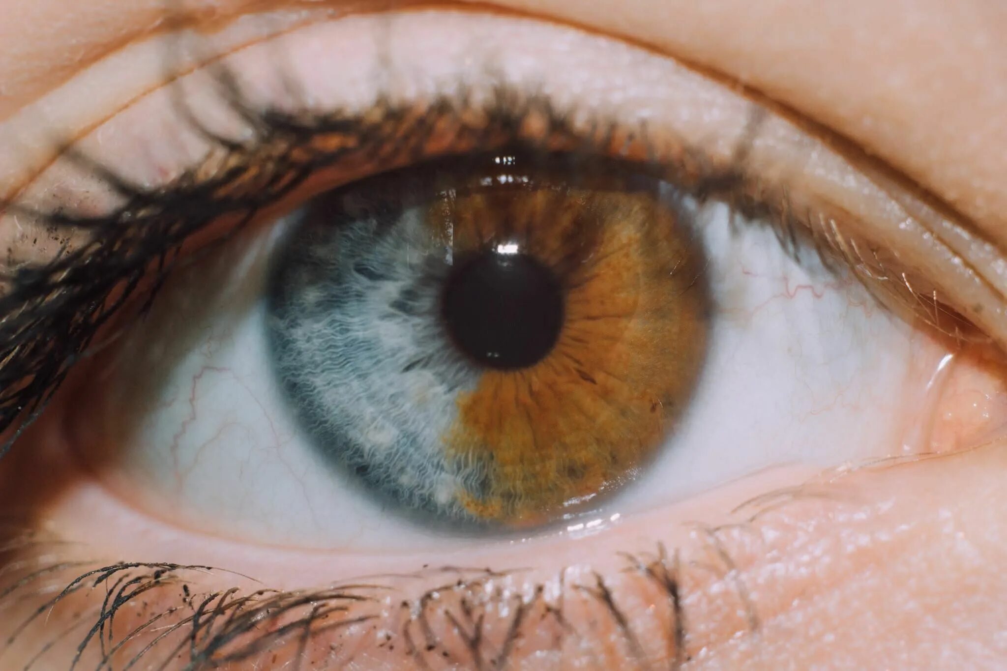 Цвет глаз человека определяется пигментацией. Металлозная гетерохромия. Гетерохромия радужной оболочки. Гетерохромия центральной Радужки. Гетерохромия Радужки глаз.