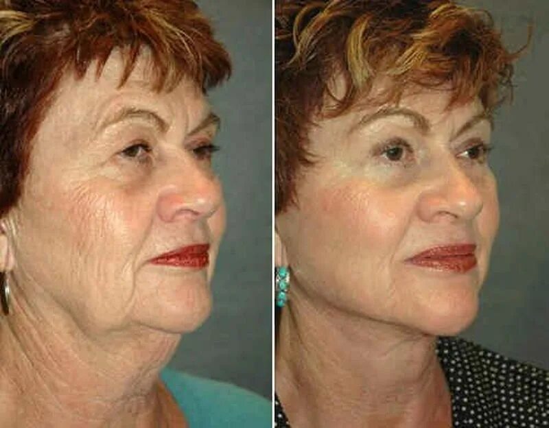 Плазмотерапия лица до и после. До и после плазмолифтинга лица. Плазмолифтинг лица до и после. Поазмо лифтинг до и после.