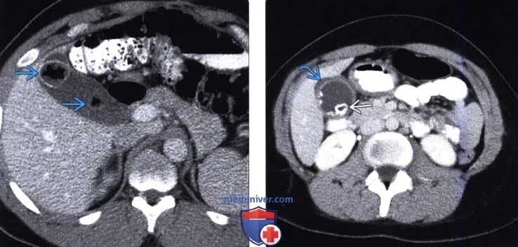 Холестериновые конкременты желчного пузыря кт. Холестериновые камни в желчном пузыре на кт. Конкременты желчного пузыря на кт. Камни желчного пузыря на кт. Камни в желчном кт