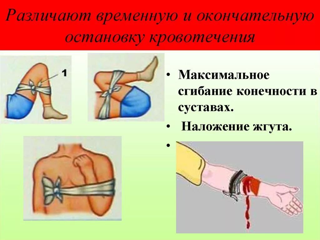 Наложение жгута при кровотечениях. Наложение жгута и максимальное сгибание конечности в суставе. Алгоритм наложения жгута на конечность. Алгоритм наложения жгута при артериальном кровотечении