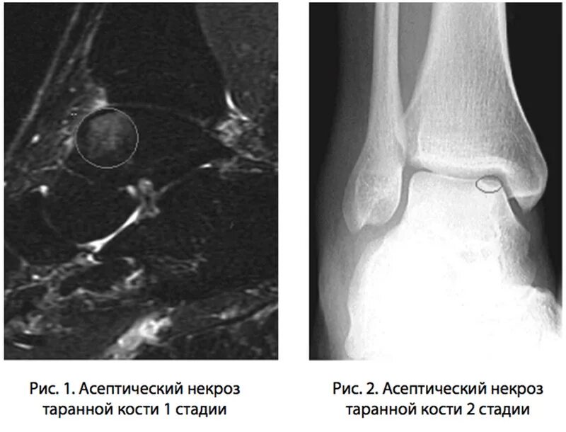 Таранная кость асептический некроз. Асептический некроз голеностопа симптомы. Асептический некроз головки таранной кости на кт. Асептического некроза костей голеностопного сустава. Контузионные изменения кости