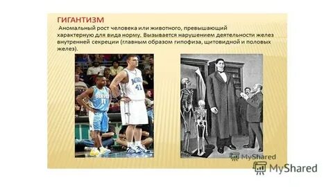 Гигантизм сахарный диабет