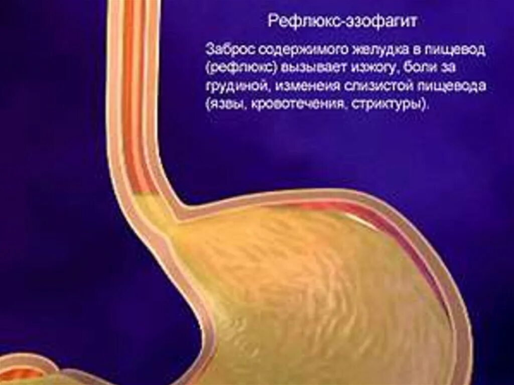Рефлюкс у подростков. Рефлюкс у подростков