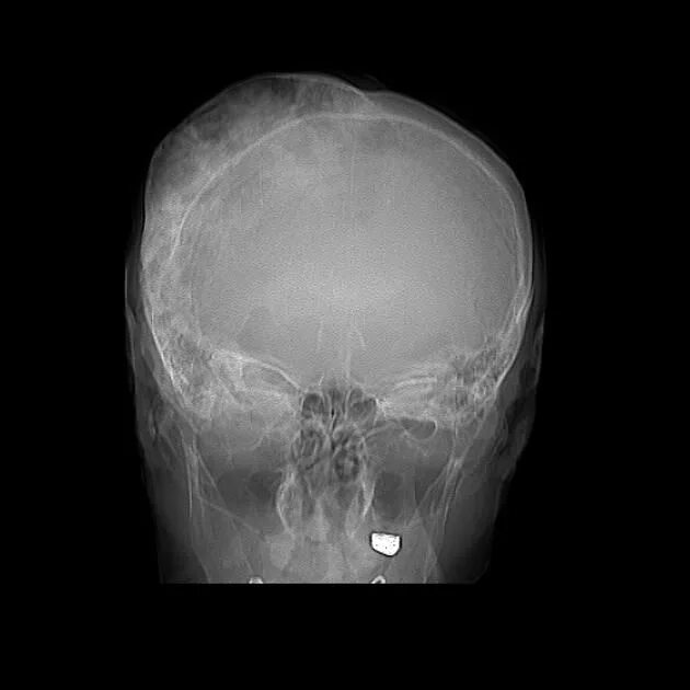 Кости черепа рентген. Остеома костей черепа кт. Остеома затылочной кости кт. Губчатая остеома черепа. Остеома лобной кости кт.