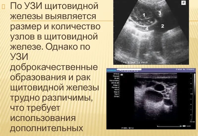 Можно ли перед узи щитовидной железы есть. УЗИ признаки злокачественности опухоли щитовидной железы. Злокачественное объемное образование щитовидной железы на УЗИ. УЗИ щитовидной железы эхограммы. Картинки ультразвуковое исследование щитовидной железы.