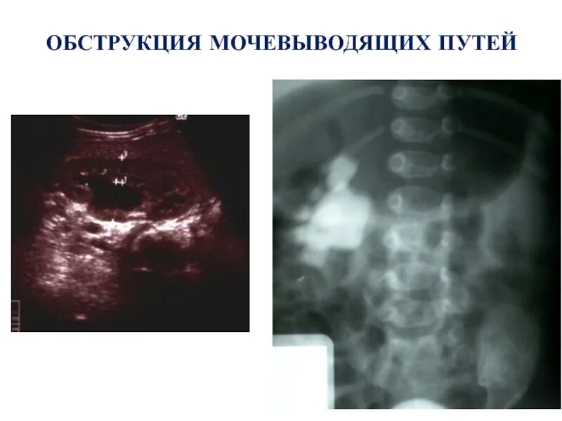 Обструкция мочеточника. Обструкция мочевыводящих путей. Обструкция мочевого пузыря. Обструкция верхних мочевыводящих путей.