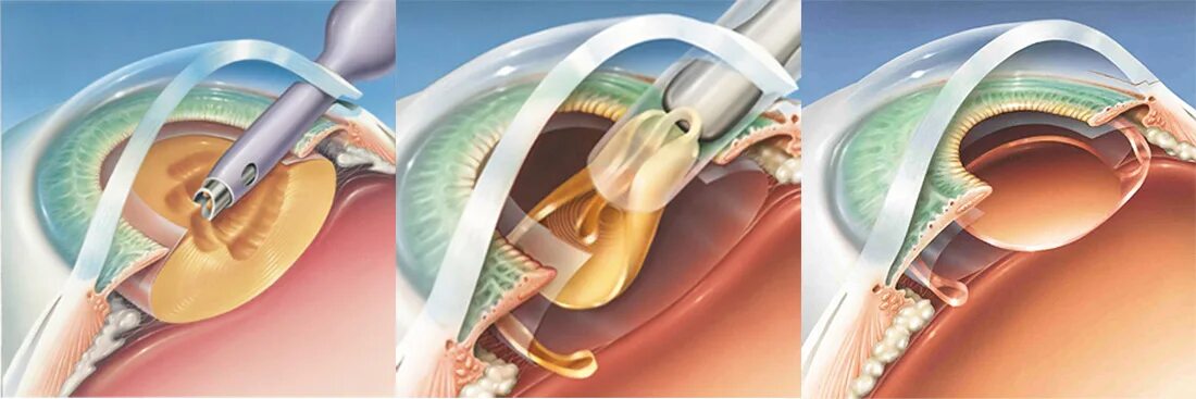 Как устанавливают хрусталик. Имплантация факичных интраокулярных линз. Ультразвуковая факоэмульсификация с имплантацией иол. Трифокальные хрусталики. Ультразвуковая факоэмульсификация катаракты этапы.
