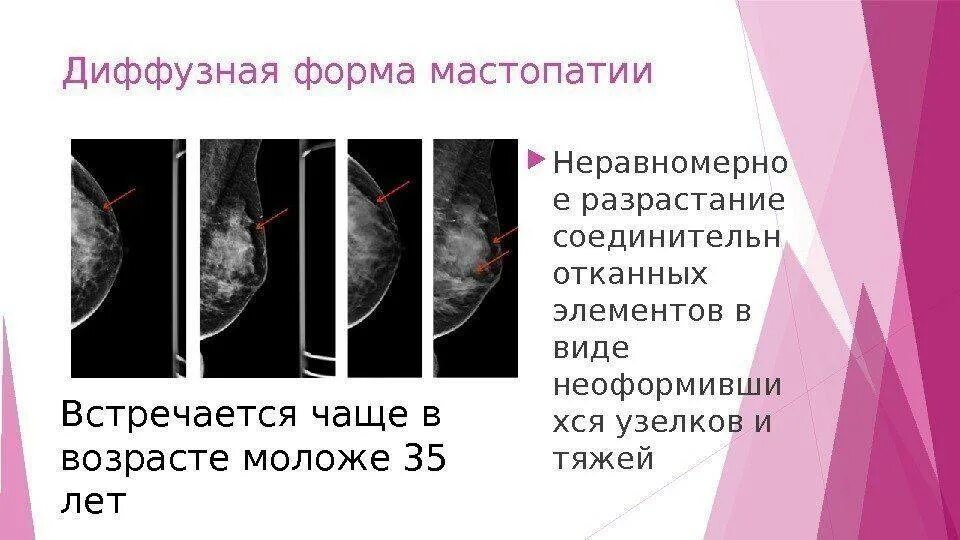 Диффузная двусторонняя фиброзно кистозная мастопатия симптомы. Фолликулярная мастопатия молочной железы. Кистозная мастопатия узи. Фиброзно кистозный мастит. Уплотнение сбоку молочной железы.