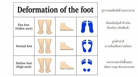 Flat footed