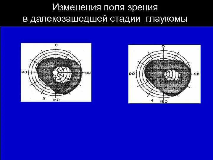 Как изменяется поле зрения