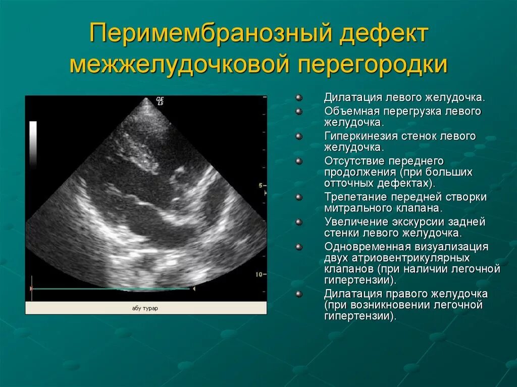 Аневризма перегородки у ребенка. Подаортальный дефект межжелудочковой перегородки. Дефект мембранозной части межжелудочковой перегородки. Субтрикуспидальный дефект межжелудочковой перегородки.