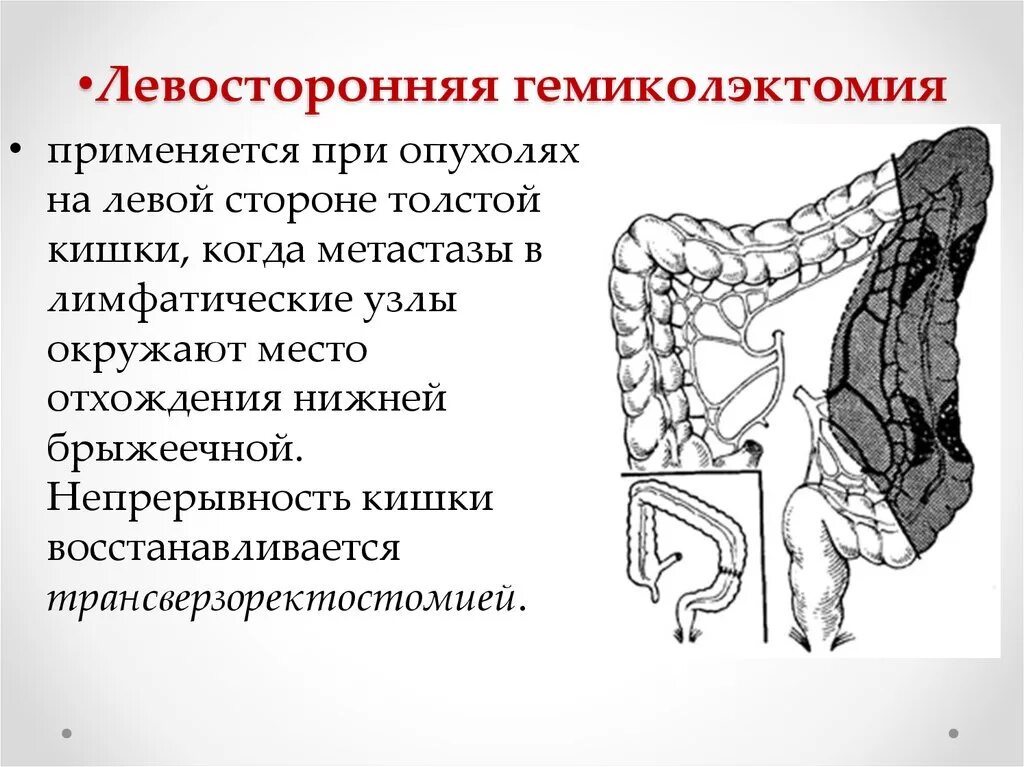 Операция толстой. Схема правосторонней гемиколэктомии. Лапароскопическая левосторонняя гемиколэктомия. Левосторонняя гемиколэктомия ход операции. Гемиколэктомия правосторонняя техника выполнения.