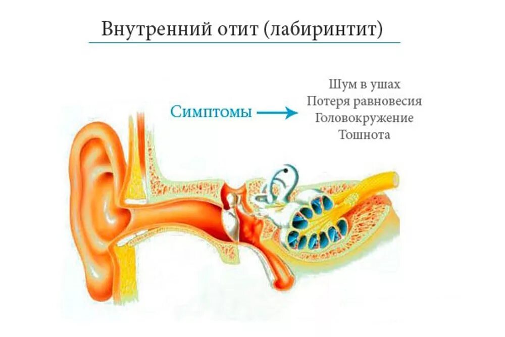 Симптомы звон. Воспаление внутреннего уха лабиринтит. Воспаление среднего уха (лабиринтит);. Воспаление среднего уха лабиринтит симптомы. Воспалительные заболевания внутреннего уха (лабиринтиты)..