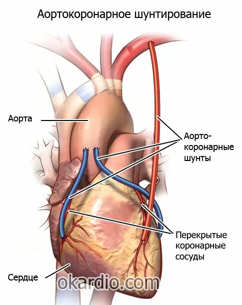 Шунтирование коронарных артерий. Аортокоронарное шунтирование операция. Коронарное шунтирование сосудов сердца. Шунтирование артерий сердца.