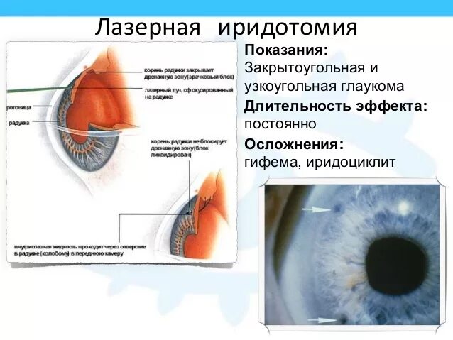 Операция лазерная иридэктомия. Лазерная комбинированная иридэктомия. Иридэктомия при глаукоме. Иридотомия и иридэктомия. Глаукома суть операции