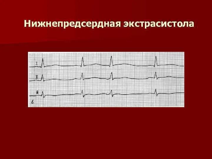 Нижнепредсердная экстрасистолия на ЭКГ. Синусово-предсердная экстрасистолия. Предсердная экстрасистолия на ЭКГ. Синусовая экстрасистолия на ЭКГ. Экстрасистолы много