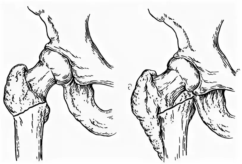 эндопротез тазобедренного сес. эндопротезирование шейки бедренной кости. шейка бедра без операции. перелом шейки бедра операция эндопротез. операция эндопротез тазобедренный.