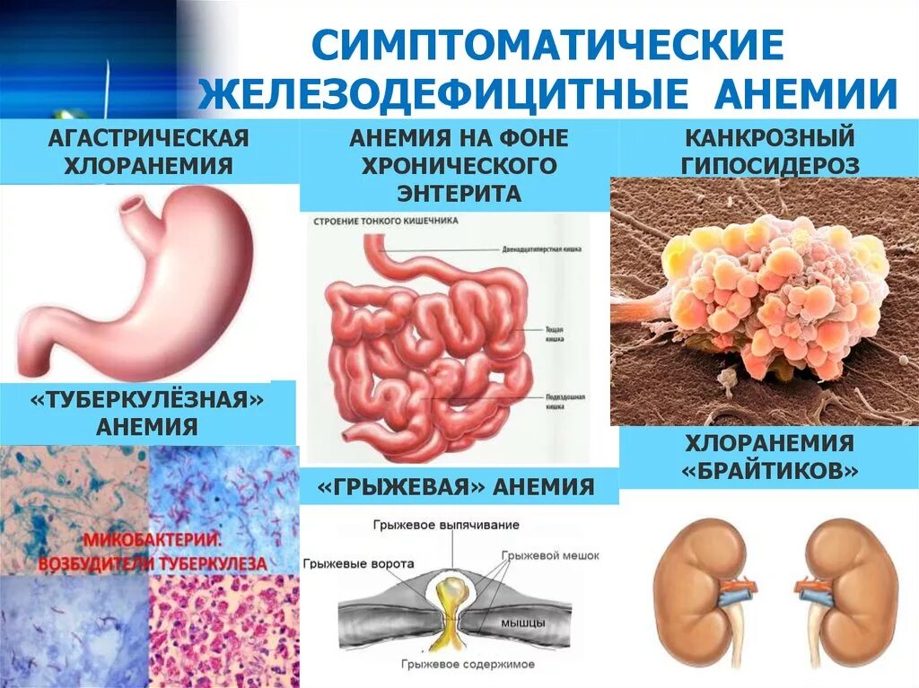 Признаки дефицитной анемии. Симптомы клинические проявления железодефицитной анемии. Основной симптом при железодефицитной анемии. Основные клинические симптомы жда. Железная анемия симптомы.