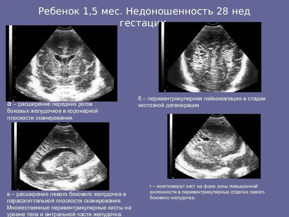 Желудочек у новорожденных