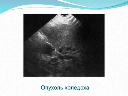 Узи поджелудочной желчный