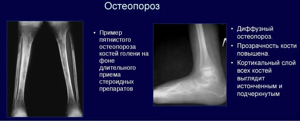 Структурные изменения костей. Диффузный регионарный остеопороз. Остеопороз на рентгене большеберцовой. Очаговый остеопороз рентген. Пятнистый остеопороз костей рентген.