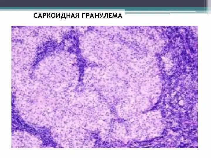 Саркоидная гранулема. Саркоидная гранулема гистология. Гистология саркоидоза. Саркоидная гранулема морфология. Саркоидные гранулемы болезнь крона.