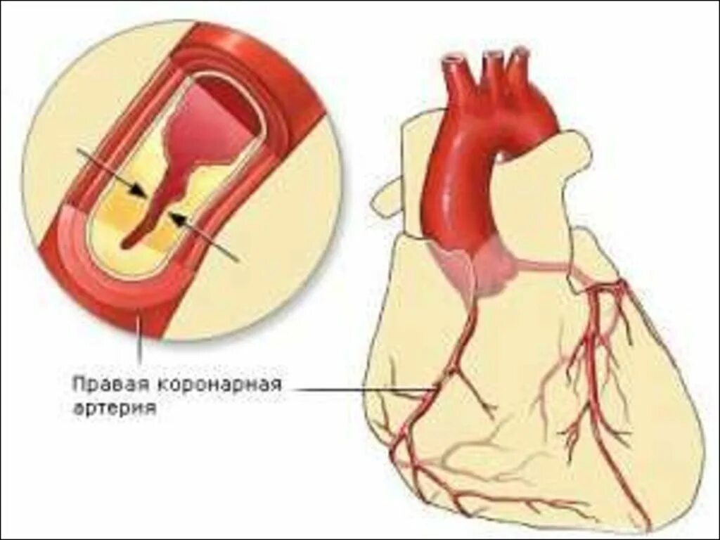 Ишемическая болезнь сердца. Причина ишемического стаща. Коррекция модифицируемых факторов риска. Ишемическая болезнь форум. Ибс код.