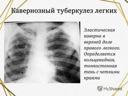 Каверна это