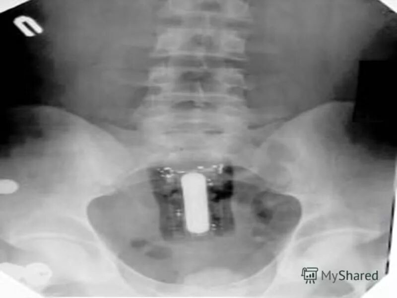посторонние предметы в интимных местах. рентген таза инородное тело. инородные из прямой кишки. инородные из прямой кишки. рентген предметов в кишке.