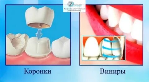 Разница между винирами и коронками