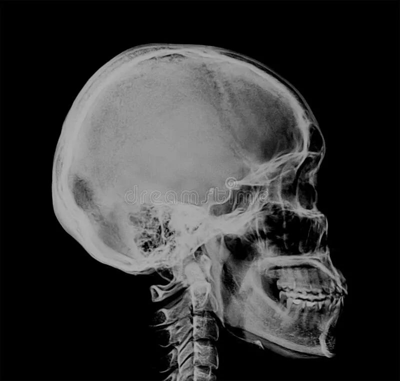 Трещина в голове. Рентгеновский снимок черепа.