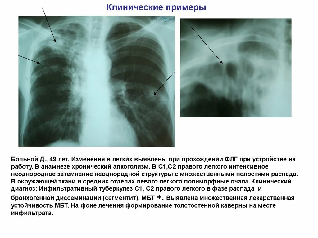 Изменение в верхнем легком. Инфильтративный туберкулез легких с1 с2 с 6. Инфильтративный туберкулез рентгенография. 1) Инфильтративный туберкулез легких. Очагово-инфильтративный туберкулез рентген.