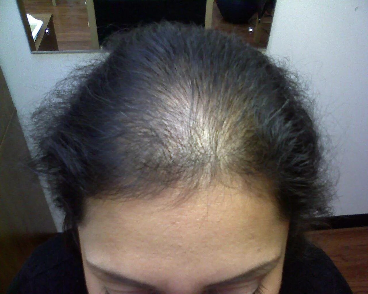 Выпадают волосы что делать причины лечение. Андрогенная алопеция алопеция. Диффузная телогеновая алопеция.