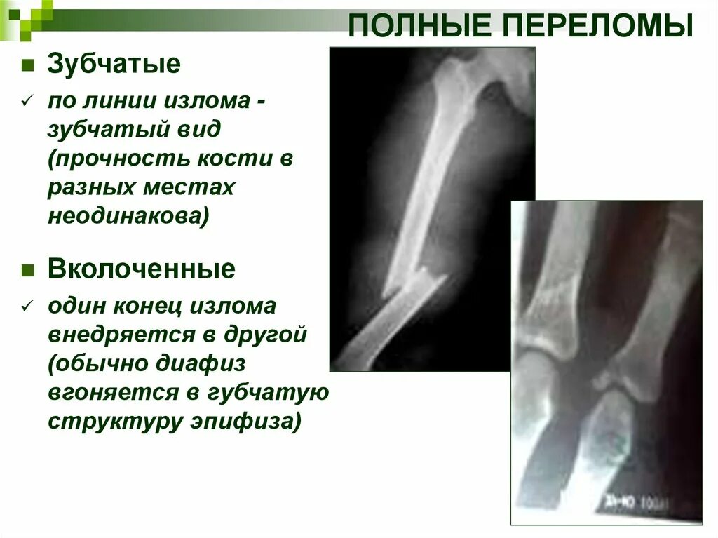 Диафизарные переломы костей голени классификация. Остеохондропатия эпифизов трубчатых костей. Классификация переломов длинных трубчатых костей. Смещении при переломах трубчатых костей. Классификация костей трубчатые губчатые.